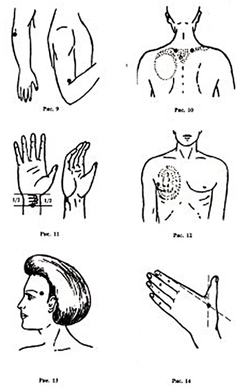 Точки валле. Пальпация точек Валле. Точки на теле. Точка Валле в неврологии. Болевые точки Валле неврология.